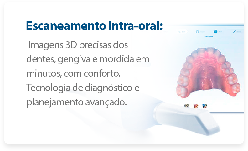 Escaneamento Intra-oral_